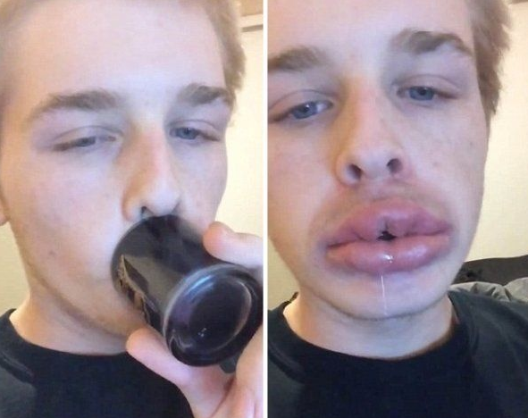 为获得像明星一样的丰满嘴唇 竟用杯子把嘴吸肿