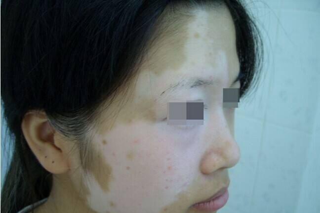 赵毅说健康:患了白癜风不能喝酒的原因是什么
