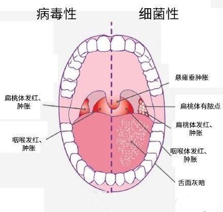 宝宝又生病了,病毒性感冒还是细菌性感冒,后悔