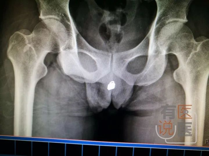 吸毒男子把锁头从尿道塞进膀胱 医生拍片后吓一跳