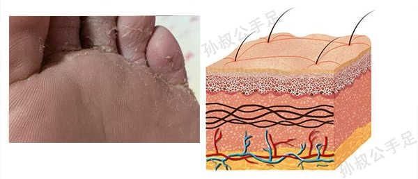 科普篇:六个案例剖析,让你认清脚气真相
