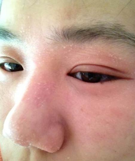 下面告诉大家,我们皮肤一旦出现过敏,脱皮.应急的方法是什么?
