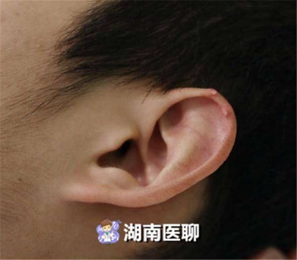 湖南人注意了!贪吃干锅肥肠猪肚,痛风可能已经