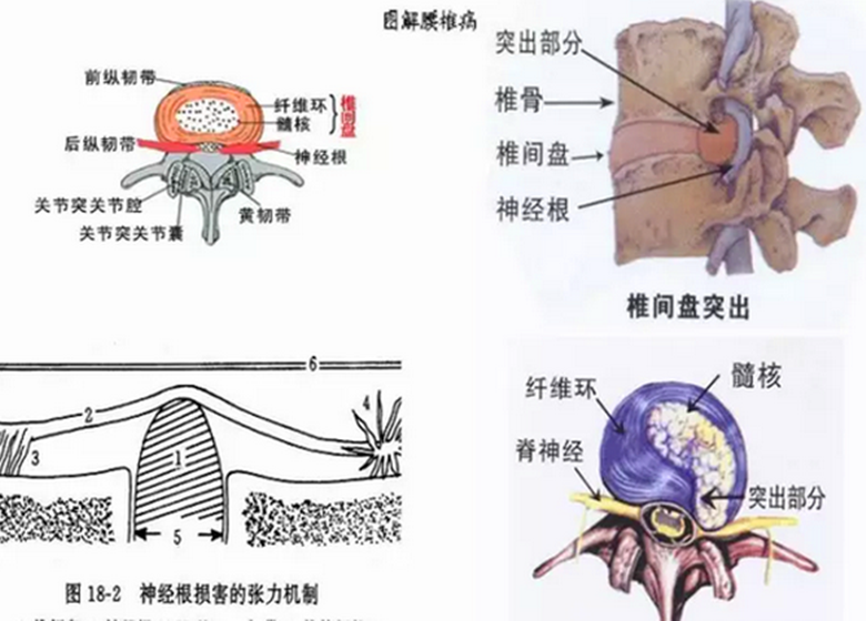 西安治疗腰椎间盘突出突出的方法,悬壶邱他们有什么好办法