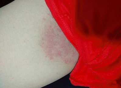 大腿根内侧瘙痒怎么治,这个方法两周就见效