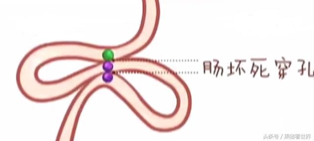 婴儿误食磁珠 反复呕吐 造成肠道穿孔
