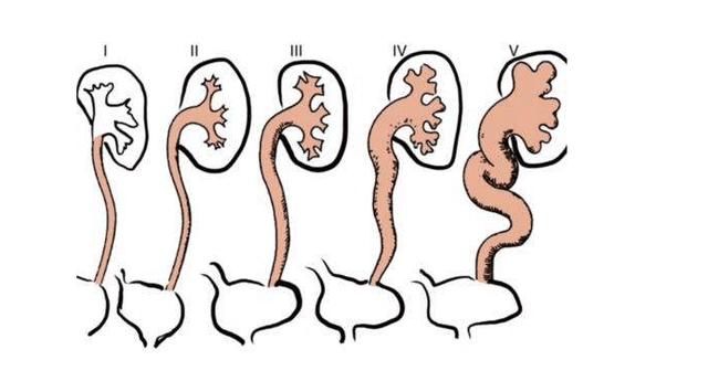 如果你有这些症状,说明尿路感染将至!