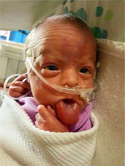 了女婴的正常呼吸,经过医生判断,她可能患有贝克威思-威德曼综合症