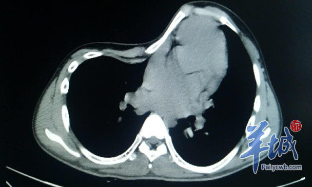 图/严重胸廓畸形,左右胸相差10公分