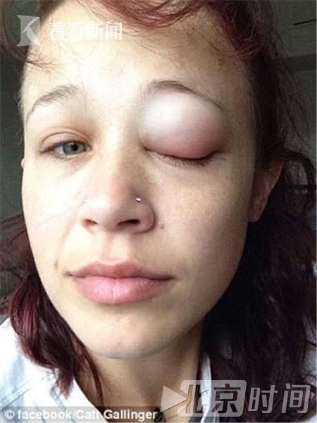 纹眼球失败眼睛肿胀流水睁不开 妙龄女欲摘除眼球