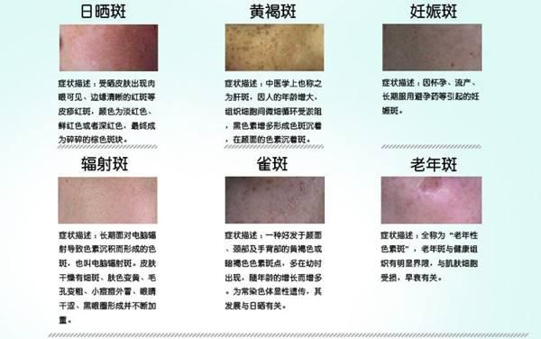 脸上有斑别再涂牙膏了,药房里的它专门对付各