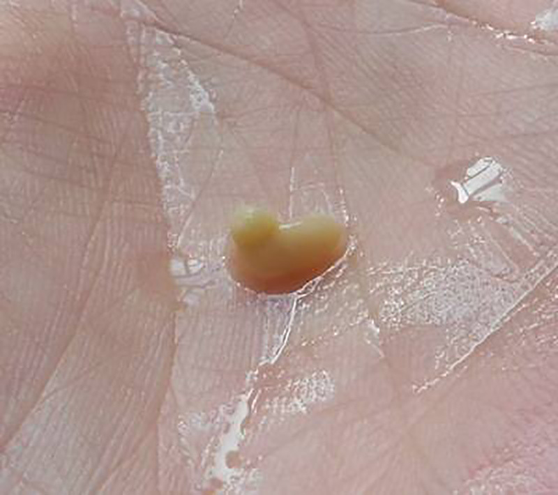 小姑娘口臭多年,医生检查说是扁桃体结石,现在