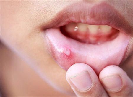 迁延难愈),积极消除病因,并使用药物治疗(一般来说,可以适用锡类散,冰