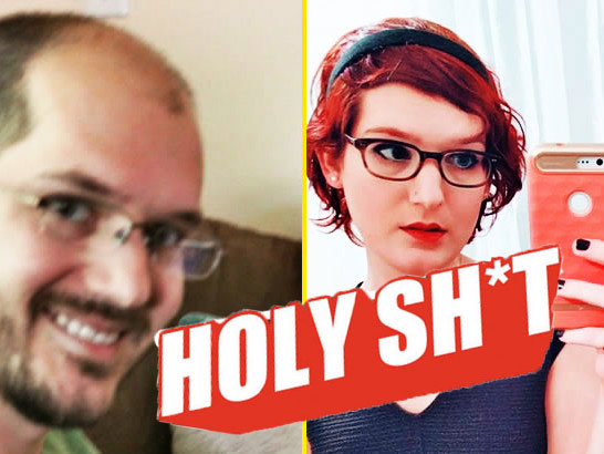 【holy shit】秃头男子连续服用雌激素,不仅长出头发还.