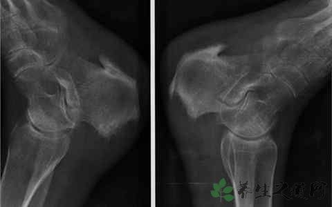 膝盖骨质增生原因