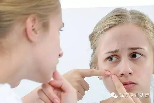 成人痘 是后青春期的梦魇 成人痘 是后青春期的梦魇