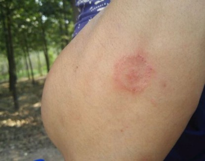 金钱癣怎么根治，坚持正确用药效果好