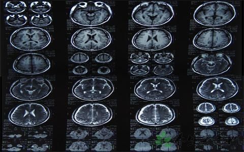 头部核磁检查副作用