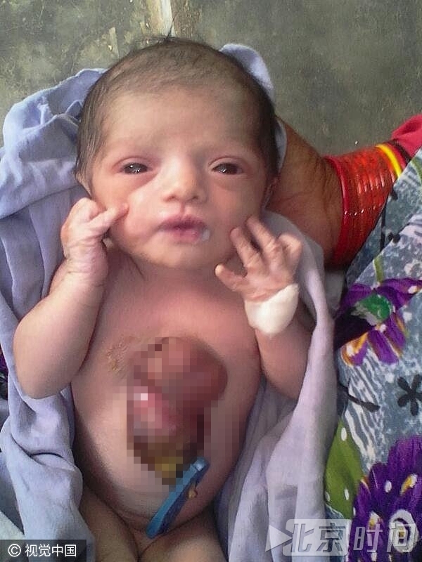 24岁的父亲 Arvind Patel 的职业是警卫员，他表示因为这个事情，整个家庭几乎崩溃。他表示妻子在怀孕期间经常做检查，但是还是发生了这样的事情。