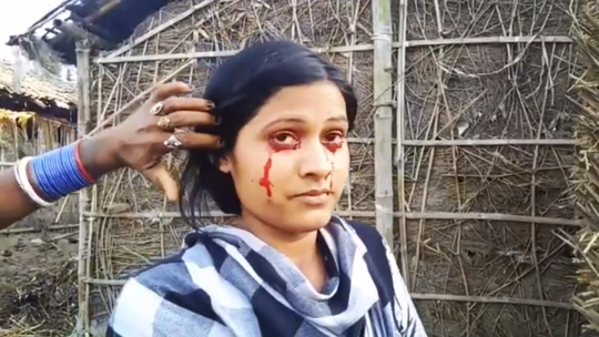 21岁印度女子患怪病 眼睛身体流血被当地人称作女巫