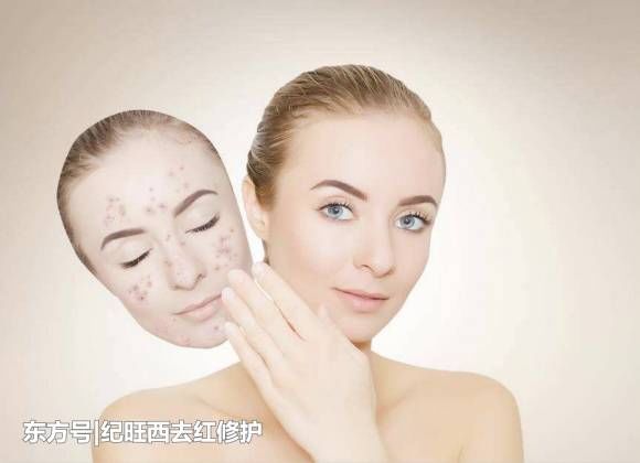 滥用糖皮质激素造成激素脸怎么办 激素皮炎症