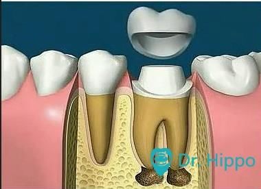 根管治疗后,为什么还要做烤瓷牙冠?