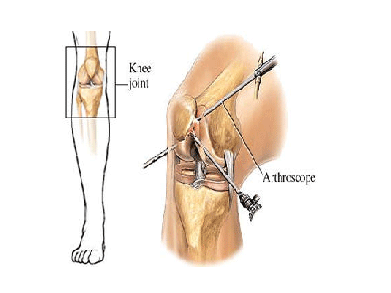 滑膜炎危害大,治疗和日常保养也很重要