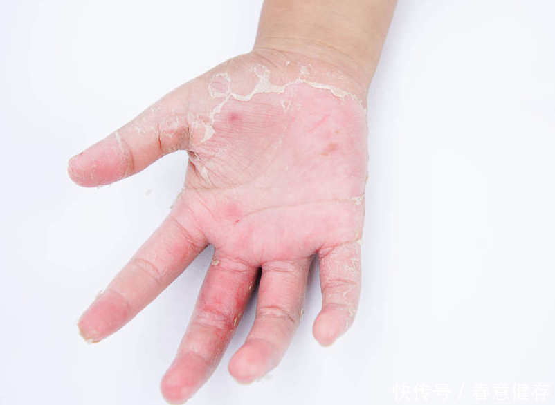 体内湿气多而引发湿疹 教你如何治湿疹祛湿气