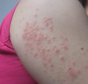 过敏性皮疹湿疹怎么治?5个小方法快速还你光