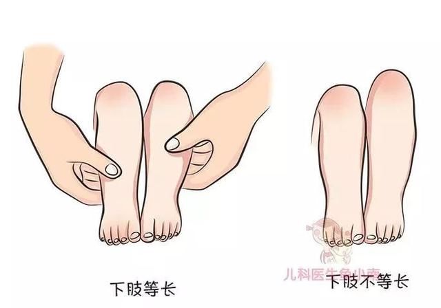 宝宝腿纹臀纹不对称就是髋关节发育不良吗?为