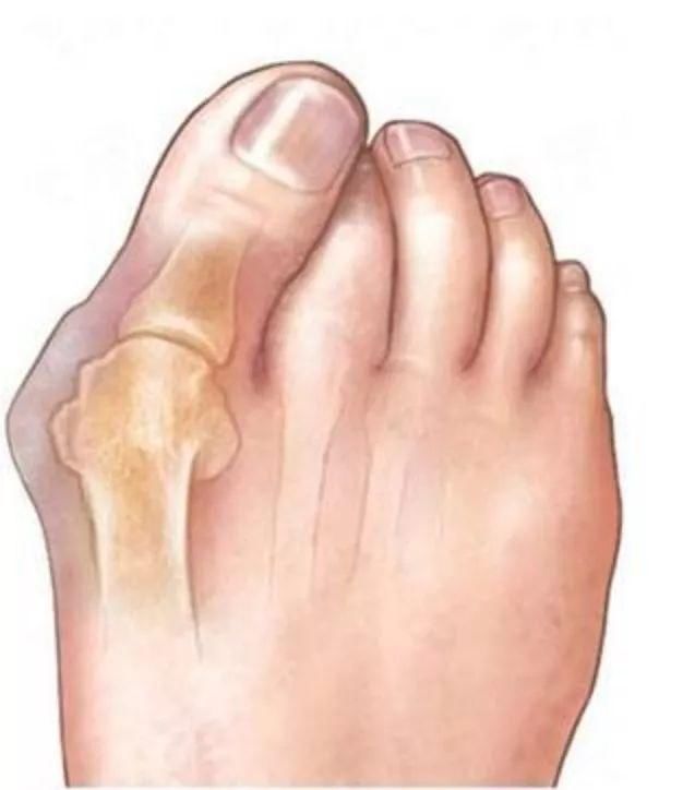 鞋子的好坏居然对孩子影响这么大(附我的惨痛