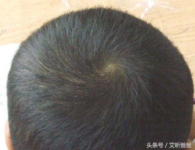 妈妈来测测,根据宝宝的头旋评估孩子的情商和智商!