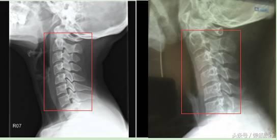 脖子痛?纳尼!我是睡了一个假的乳胶枕吗?