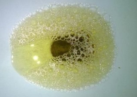 尿液中泡沫增多是怎么回事?泡沫尿是不是肾不好?