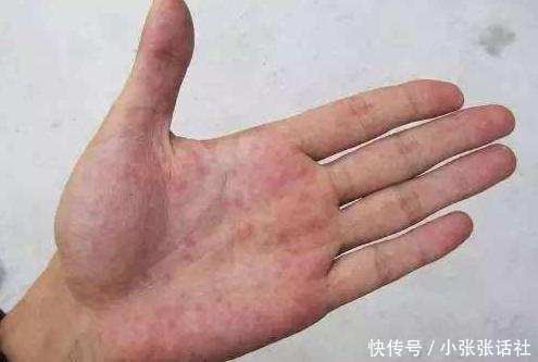 身体出这6大表现, 可能是肝脏发出求救信号!