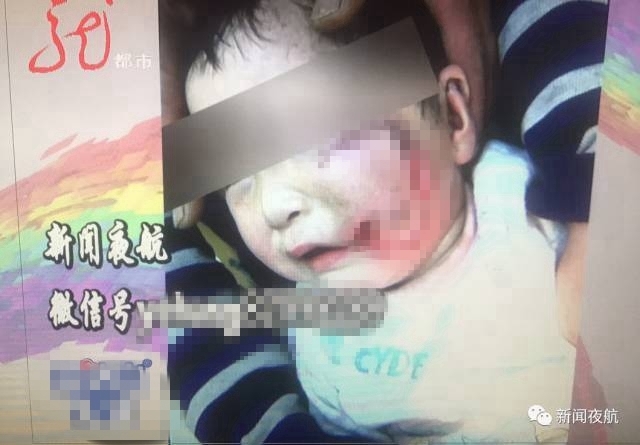 2岁男孩被看门土狗咬伤 右脸皮肤裂开缝30多针