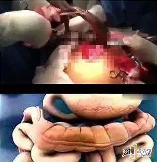 身体长铁丝肠道中取出活鱼 这些事情全是真的! 身体长铁丝肠道中取出活鱼 这些事情全是真的!