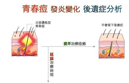 青春痘产生的五大原因,据合肥专家说:这些痘友