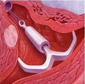 怀孕分娩后不想生了,你会选择上环避孕吗?