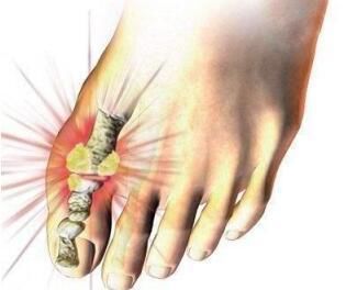 痛风是嘌呤代谢紊乱所致的疾病,饮食应做到五