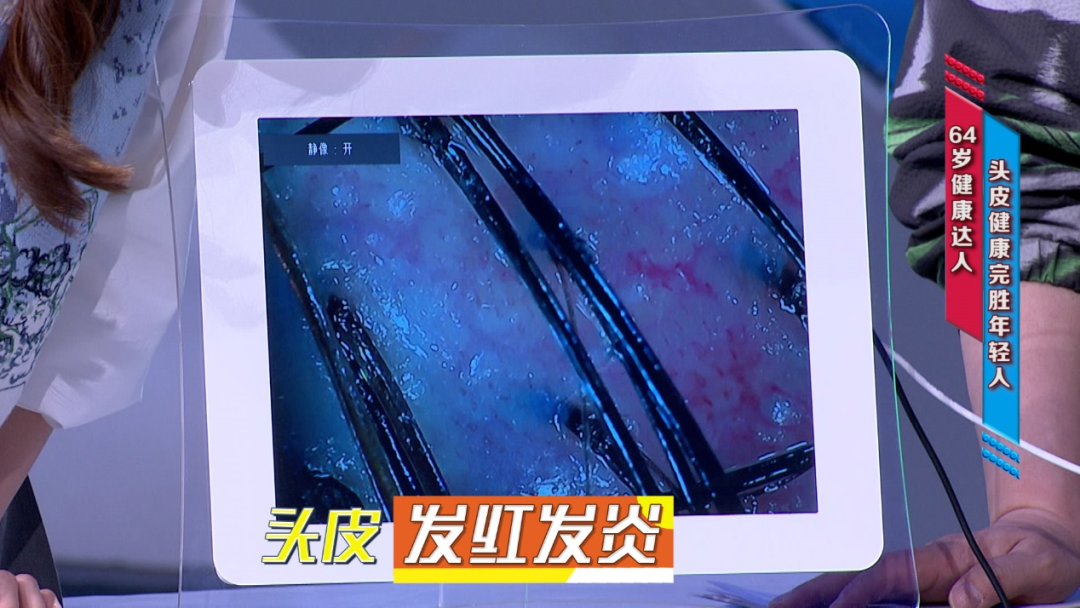 s8怎么保养【我是大医生】头皮保养 年轻的“头等”秘诀!_北京时间_新闻资讯_第6张_活检穿刺产品网 s8怎么保养【我是大医生】头皮保养 年轻的“头等”秘诀!_北京时间_https://www.jmylbn.com_新闻资讯_第6张