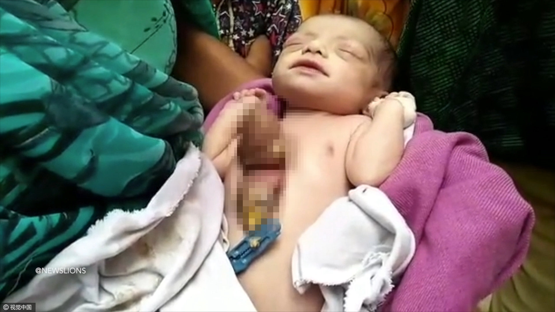 印度新生女婴心脏长在胸外 仅有50%的存活几率