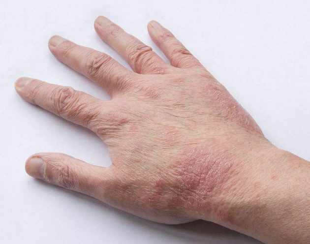 手癣和湿疹有什么区别,分不清麻烦可就大了