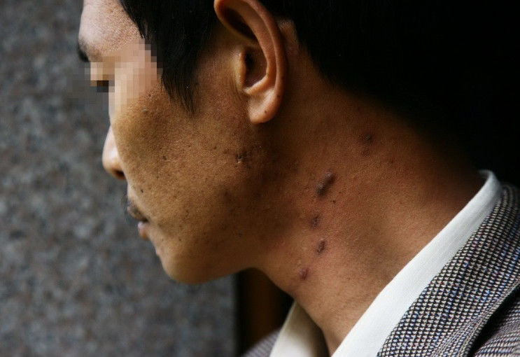 男子的脖子长出明显脓包.
