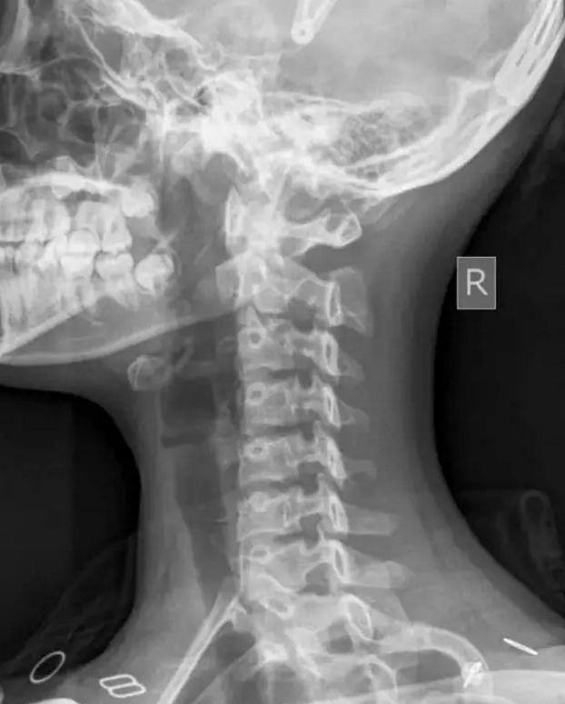 颈椎X光片的读片要点&常见异常改变