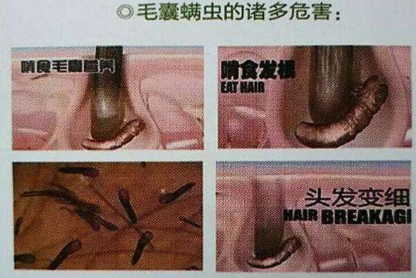 头发掉的厉害,变细变软,容易出油还长痘痘小疙