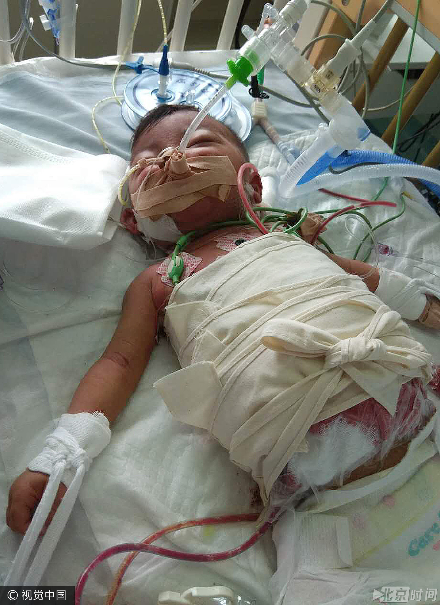 2017年1月，刚刚出生不久的小梦涵突然哭闹不停，父母将她送去当地医院就诊。医院诊断为先天性胆道闭锁病，医生告诉她父母，要立刻住院进行手术。听闻要花很多钱，小梦涵的父母选择了放弃。孩子母亲说，“花这么多钱还不如再生一个”。