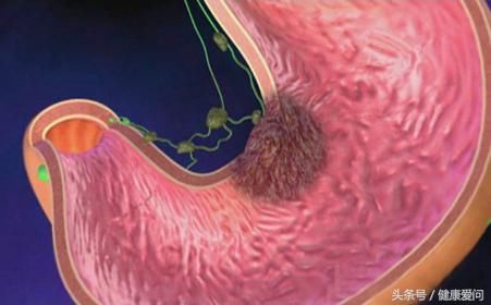 月晕而风,础润而雨,您知道胃病早期信号,怎样防