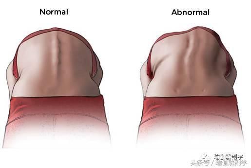 最全面的调整脊柱侧弯瑜伽理疗序列(收藏级)