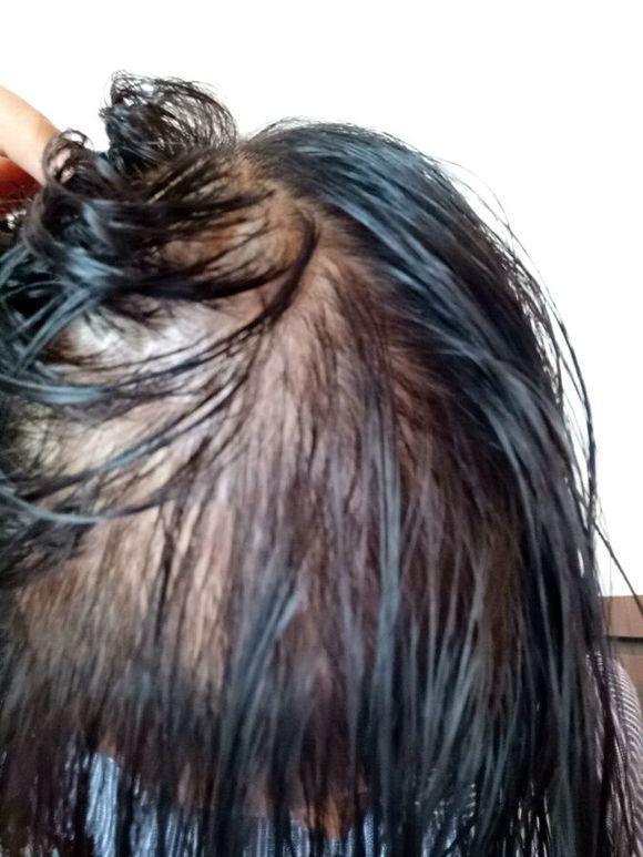 头发掉的厉害,变细变软,容易出油还长痘痘小疙